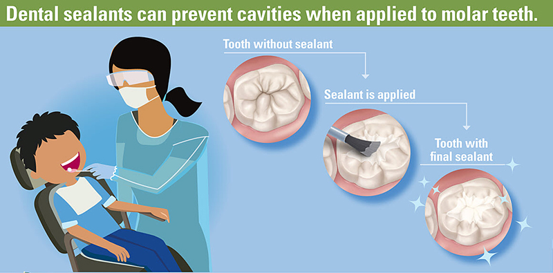 Dental Sealant Infographic